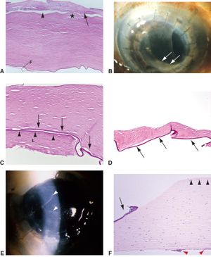 Corneal graft failure - American Academy of Ophthalmology