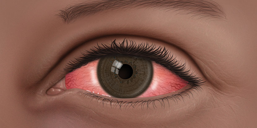 Conjunctivitis: What Is Pink Eye? American Academy of Ophthalmology