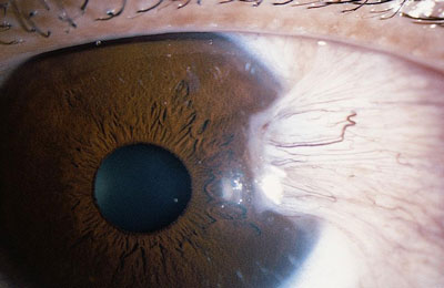 Pinguecula: Yellow bump on eye, Causes & treatment