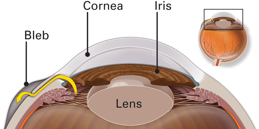 Procedures Combined with Cataract Surgery
