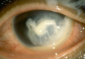 What Is Keratitis? - American Academy of Ophthalmology