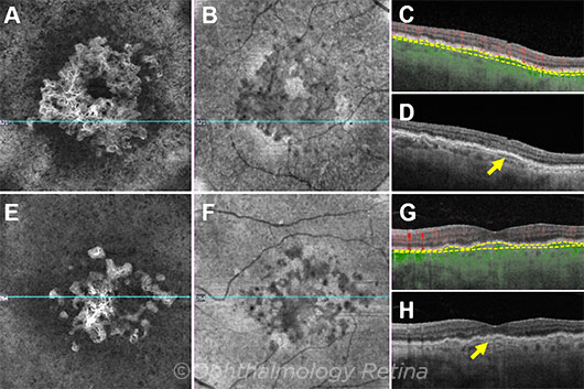 Using the Double-Layer Sign to Predict Subclinical Macular  Neovascularization - American Academy of Ophthalmology