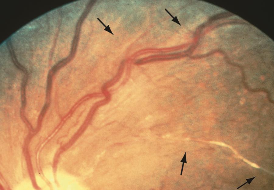 Hypertensive retinopathy American Academy of Ophthalmology