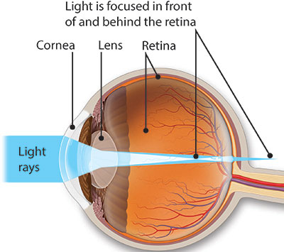 astigmatism eye