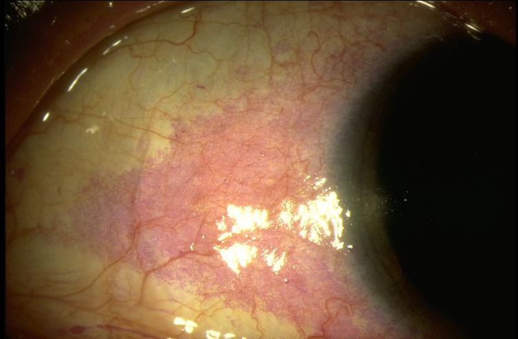 Keratoconjunctivitis sicca - American Academy of Ophthalmology