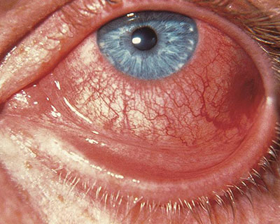 Pink Eye (Conjunctivitis) Treatment and Diagnosis