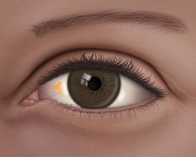 Six Things To Know about Pinguecula and Pterygium - American Academy of  Ophthalmology