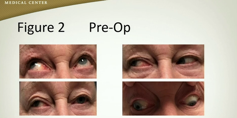 Third Nerve Palsy Surgery - American Academy of Ophthalmology