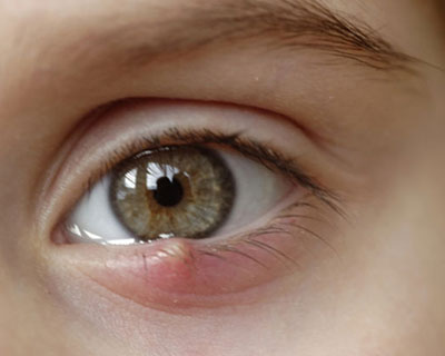 What Are Chalazia and Styes? - American Academy Ophthalmology