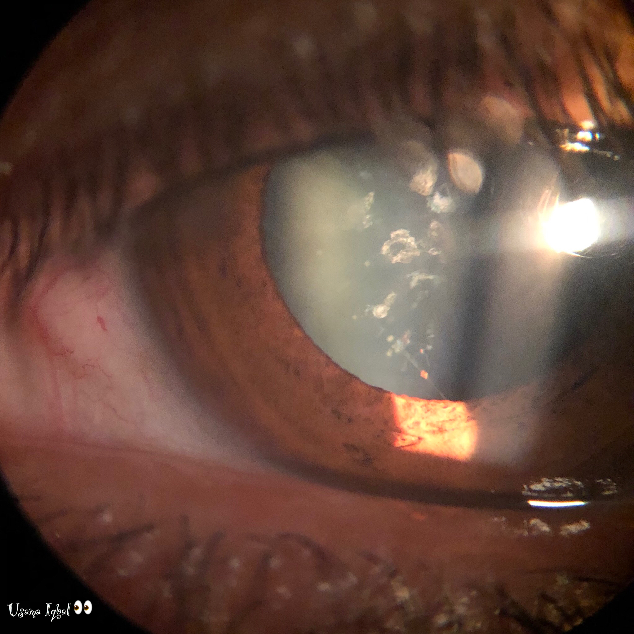 cataract congenital aao ophthalmology