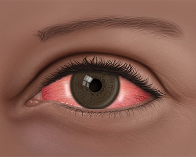 acne rosacea eyes