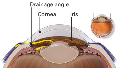 What Is Chronic Angle-Closure Glaucoma? - American Academy of