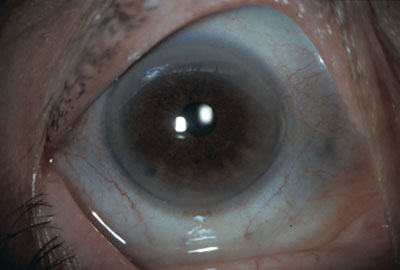  eye, demonstrating bluish discoloration of nasal and temporal sclera