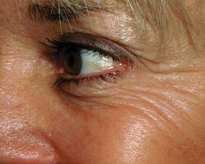 Botulinum Toxin (Botox) for Facial Wrinkles - American Academy of  Ophthalmology