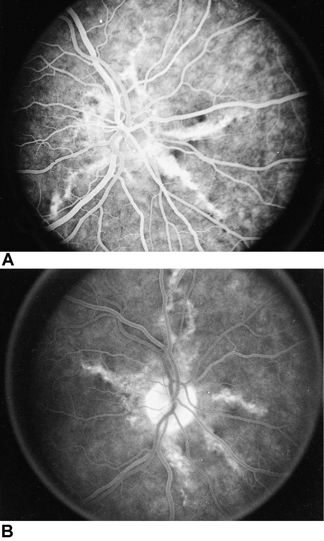 Angioid Streaks American Academy Of Ophthalmology