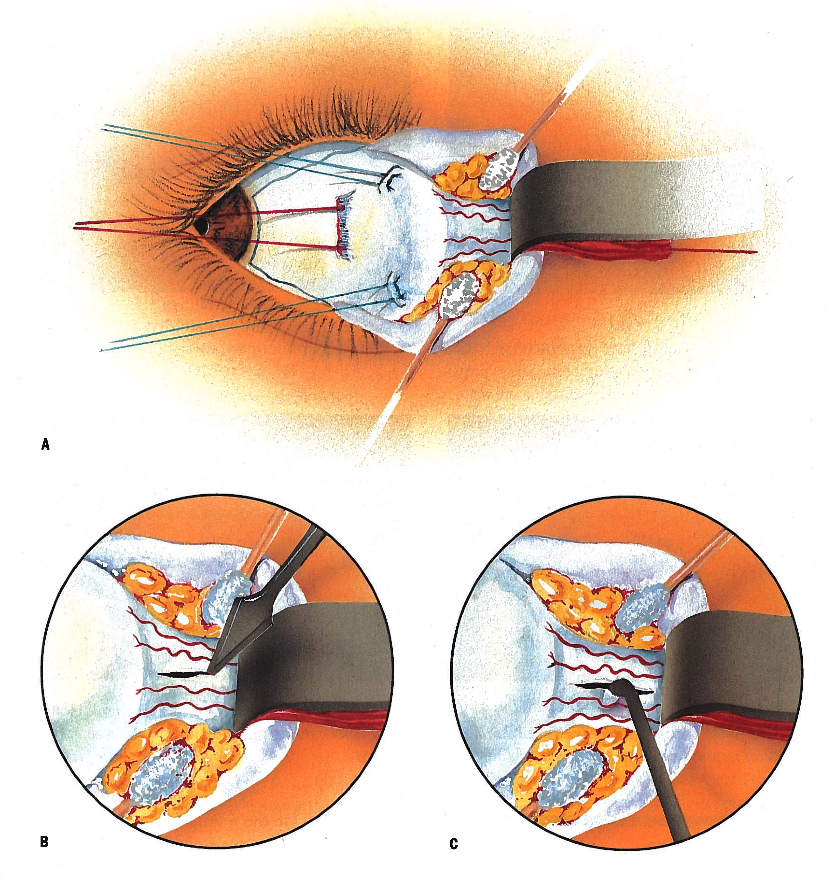 What is the success rate of optic nerve surgery?