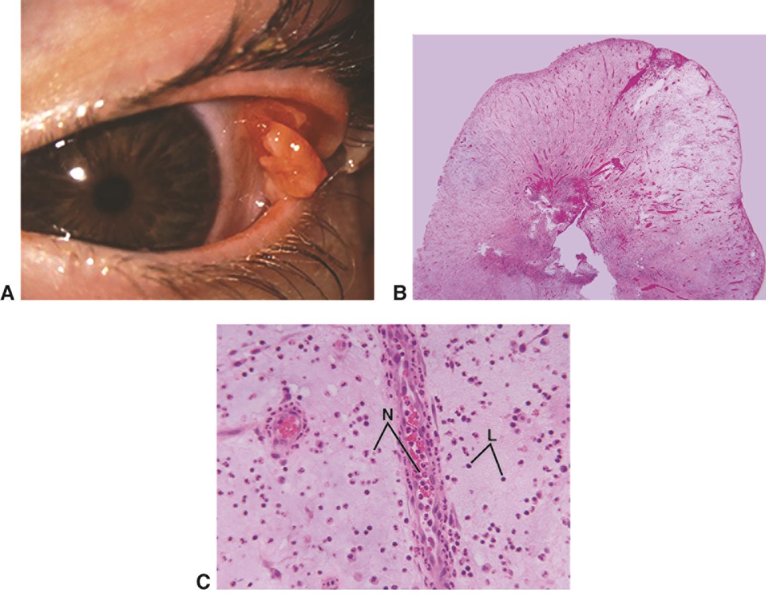 Pyogenic granuloma - American Academy of Ophthalmology