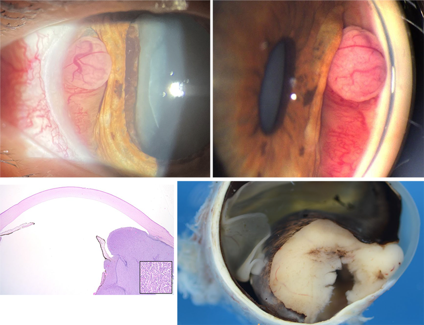 Fig. 1: Slit-lamp biomicroscopic examination showing temporal conjunctival sentinel vessels. Fig. 2: Gonioscopy revealing a vascularized pink mass. Figs. 3,4: Pathology images.