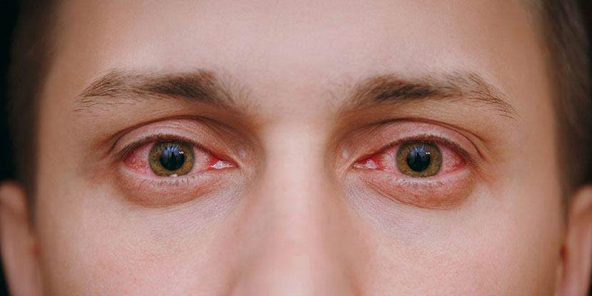 Gotas para aliviar los ojos rojos - American Academy of Ophthalmology