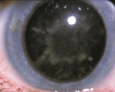 cataracts types