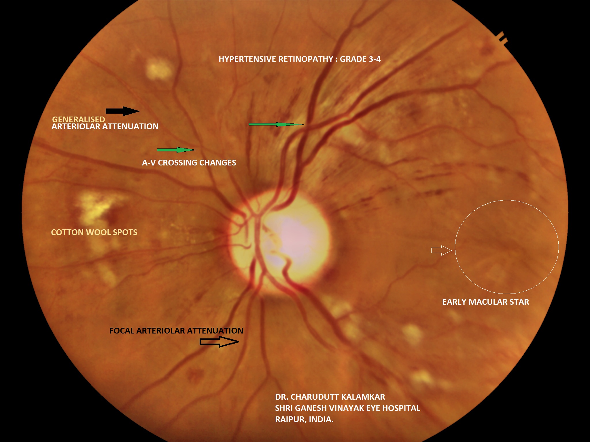 Тромботическая ретинопатия