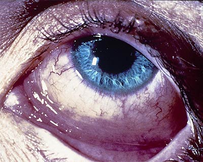 What is Conjunctivitis?, Blog, Indiana Eye Clinic