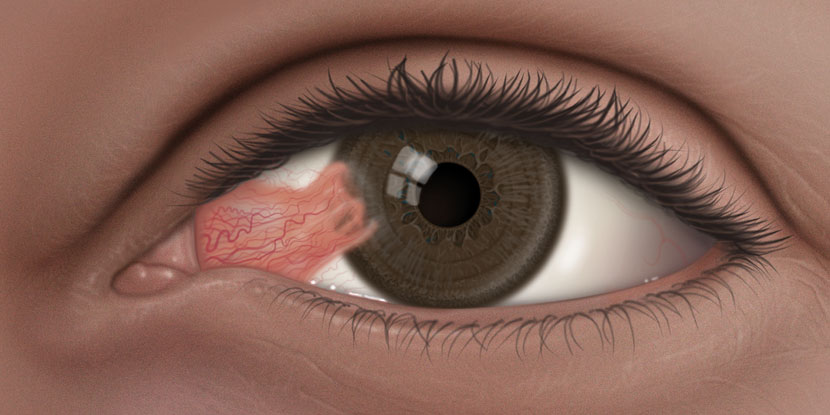 Bump on Eyeball: Causes, Symptoms, and Treatment