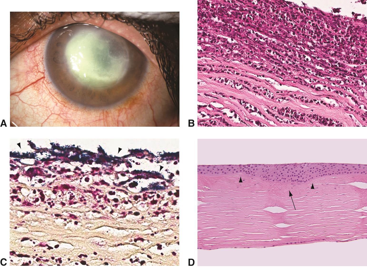 Bacterial ulcer - American Academy of Ophthalmology
