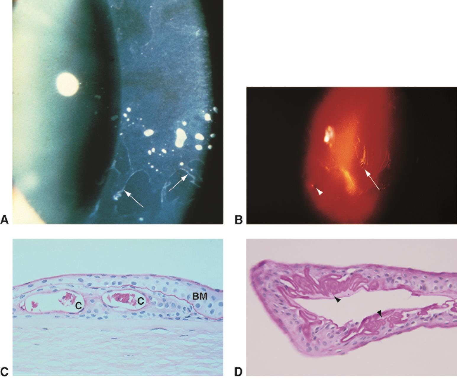 Epithelial basement membrane dystrophy - American Academy of Ophthalmology