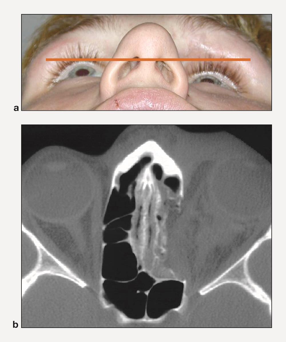 Enophthalmos and orbital wall fracture - American Academy of Ophthalmology