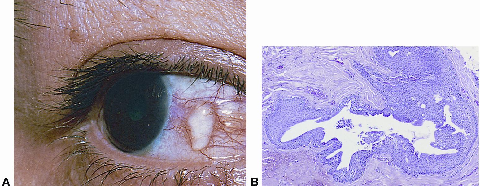 A Epithelial Inclusion Cysts May Follow Conjunctival Trauma B The