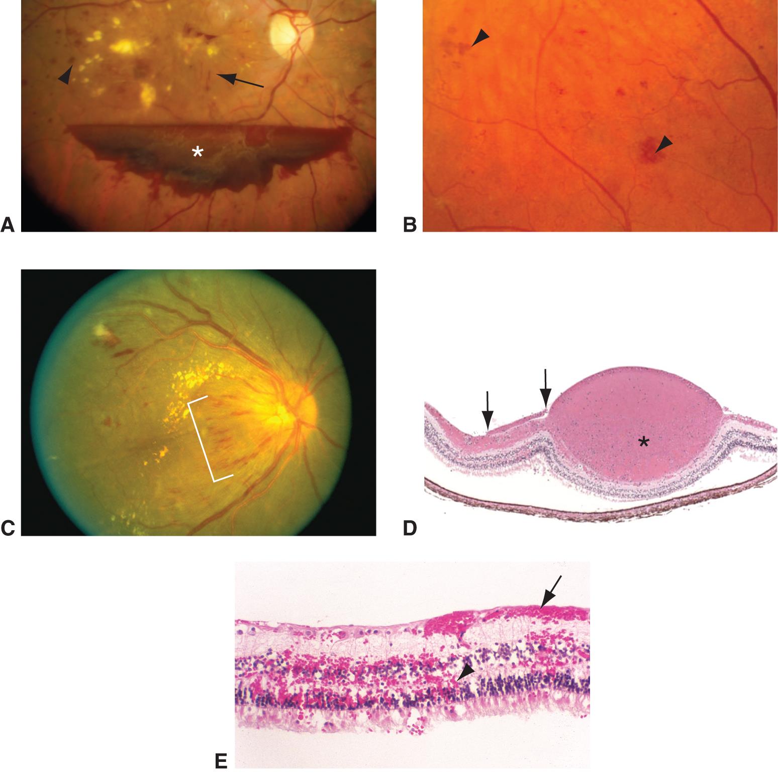 Eye Hemorrhage Anatomy