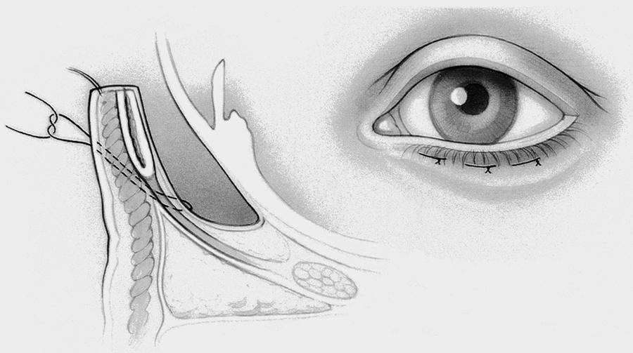 Quickert Suture Placement American Academy Of Ophthalmology