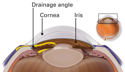 narrow angle eye condition