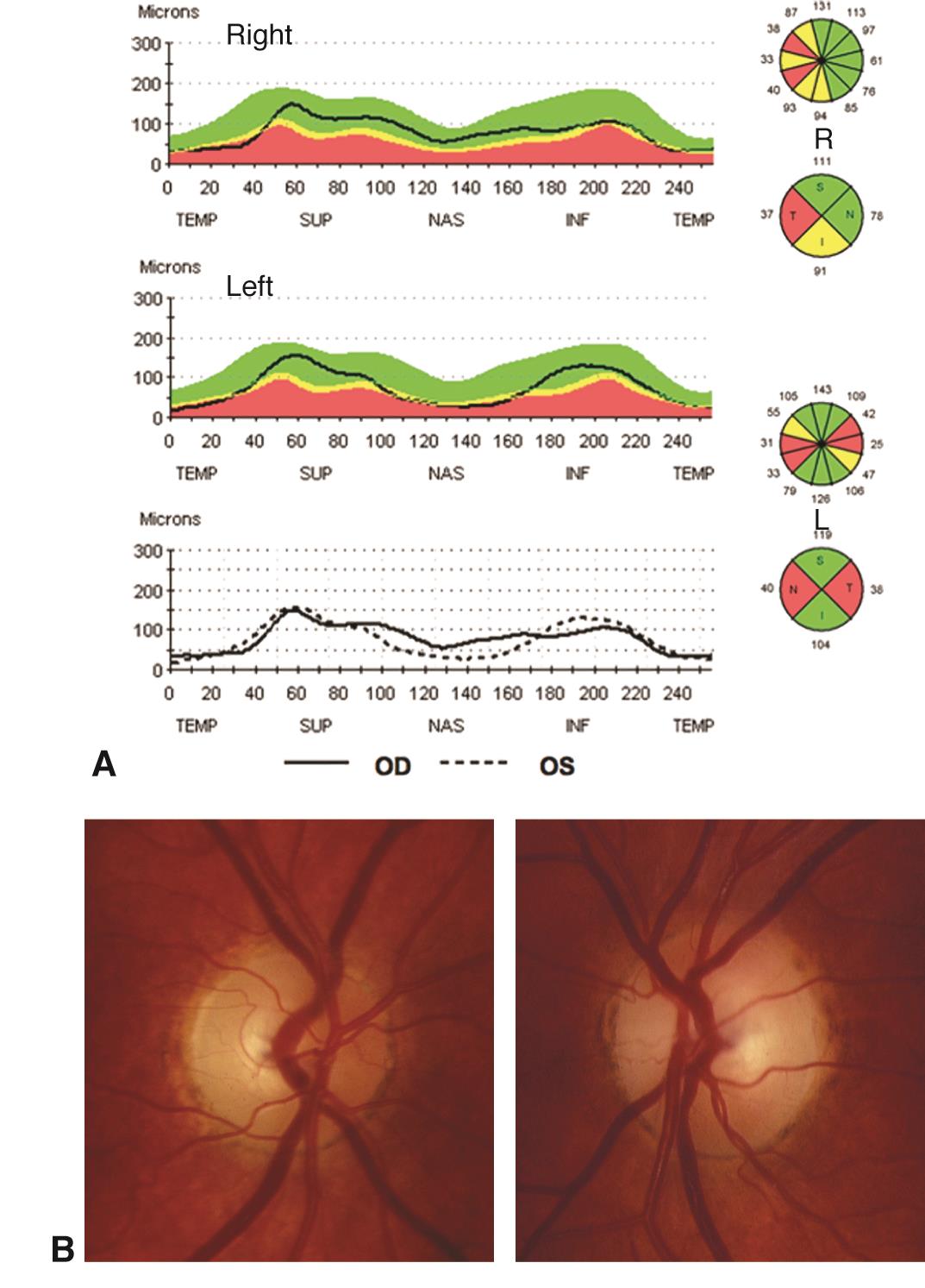 Pituitary Adenoma With Bitemporal Visual Field Loss American Academy Of Ophthalmology 